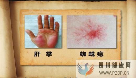 肝病多数是“拖”出来的,肝病的7个症状,你占了几...(图5) 肝病多数是“拖”出来的,肝病的7个症状,你占了几...(图5)