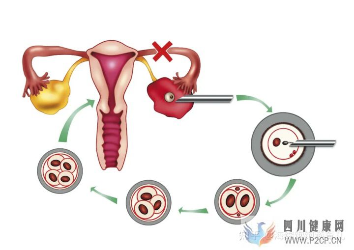 试管婴儿1代、2代、3代、4代哪个最好真实操作过...(第二代试管婴儿成功率有多少)(图7)