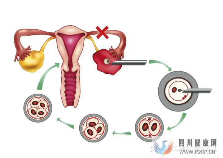 试管婴儿1代、2代、3代、4代哪个最好真实操作过...(第二代试管婴儿成功率有多少)(图8)