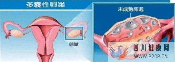 多囊卵巢综合征对试管婴儿成功率有哪些影响如何及时调理(38岁做试管婴儿成功率有多少)(图1) 多囊卵巢综合征对试管婴儿成功率有哪些影响如何及时调理(38岁做试管婴儿成功率有多少)(图1)