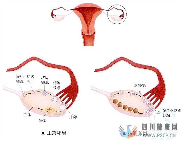 多囊卵巢综合症能做试管婴儿吗？成功率多少(38岁做试管婴儿成功率有多少)(图1)