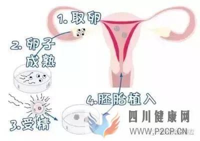 试管婴儿的一个基本流程和周期时间(二代试管婴儿需要多长时间)(图1) 试管婴儿的一个基本流程和周期时间(二代试管婴儿需要多长时间)(图1)