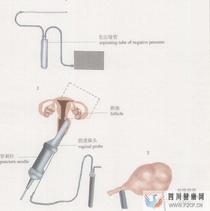 干货女性取卵全过程(两个女生试管婴儿怎么做的全过程)(图5)