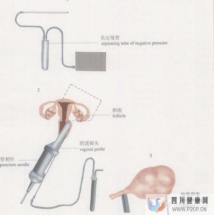 干货女性取卵全过程(两个女生试管婴儿怎么做的全过程)(图5) 干货女性取卵全过程(两个女生试管婴儿怎么做的全过程)(图5)