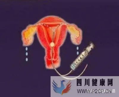 输卵管堵塞到底是先做手术,还是直接试管婴儿(女方输卵管堵塞做试管婴儿需要多长时间)(图6)