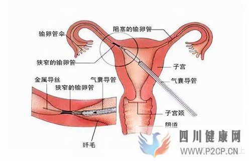 输卵管阻塞何时可以做试管婴儿(女方输卵管堵塞做试管婴儿需要多长时间)(图1)