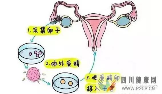 输卵管通而不畅能做试管婴儿吗(女方输卵管堵塞做试管婴儿需要多长时间)(图3)
