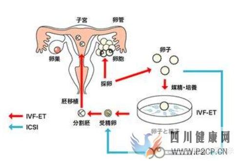 最全面详解试管婴儿具体流程(试管婴儿步骤过程详细百度)(图5) 最全面详解试管婴儿具体流程(试管婴儿步骤过程详细百度)(图5)