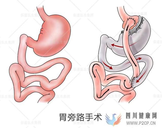 这个方法不仅能减肥,还能治糖尿病!(图1) 这个方法不仅能减肥,还能治糖尿病!(图1)