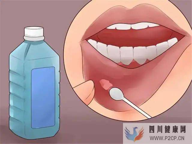 口腔炎、口腔溃疡怎么治？(图1)