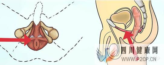 男性PC肌锻炼,凯格尔运动男性版详解(图3)