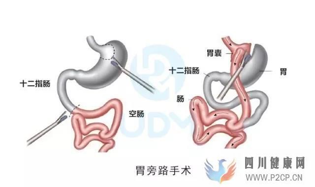 胃旁路手术能治好糖尿病吗？胃旁路手术价格是多少？(图2)