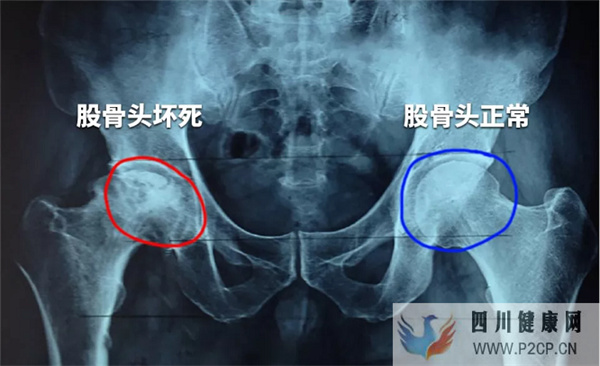 干细胞疗法对股骨头坏死的应用效果与作用机理(干细胞的作用和价格表)(图1)