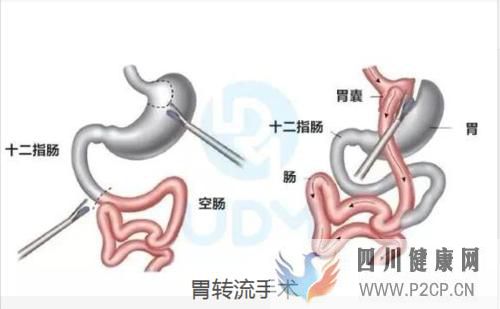 糖尿病手术治疗，血糖高可以治好吗(图1)