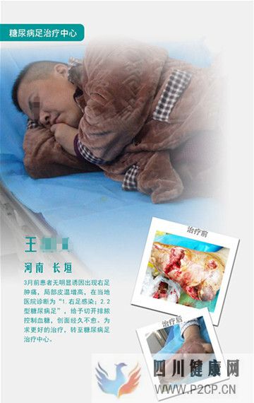 糖尿病足真的能治好吗?(图1) 糖尿病足真的能治好吗?(图1)