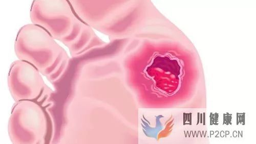糖尿病出现的烂脚不愈合该怎么治疗?(图1) 糖尿病出现的烂脚不愈合该怎么治疗?(图1)