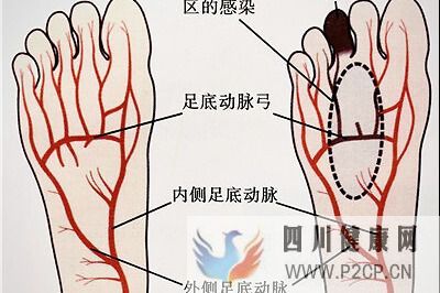 糖尿病引起的脚趾头发黑该怎么去治疗?(图1) 糖尿病引起的脚趾头发黑该怎么去治疗?(图1)