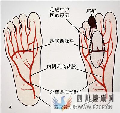 糖尿病引起的脚趾头发黑该怎么去治疗？(图2)