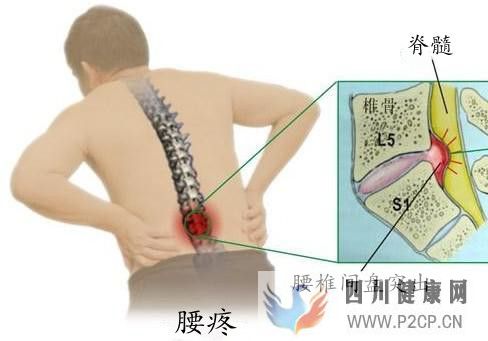 引起腰椎间盘突出的原因是什么(图4)