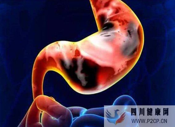 了解胃癌早期症状,胃癌发生之前身体有哪些不适症状表现(图1) 了解胃癌早期症状,胃癌发生之前身体有哪些不适症状表现(图1)