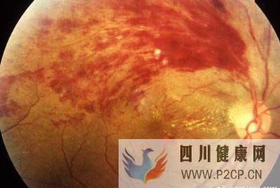 糖尿病视网膜病变能治好吗糖尿病视网膜病变的预防护理(图1) 糖尿病视网膜病变能治好吗糖尿病视网膜病变的预防护理(图1)