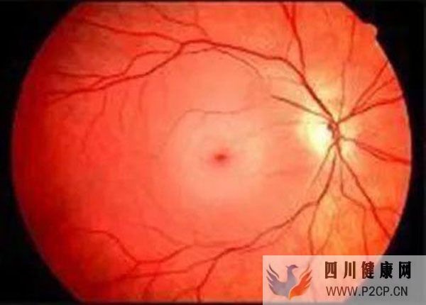 男子眼睛视力下降查出糖尿病，高血糖为何会伤眼？中医辨证疗法(图1)