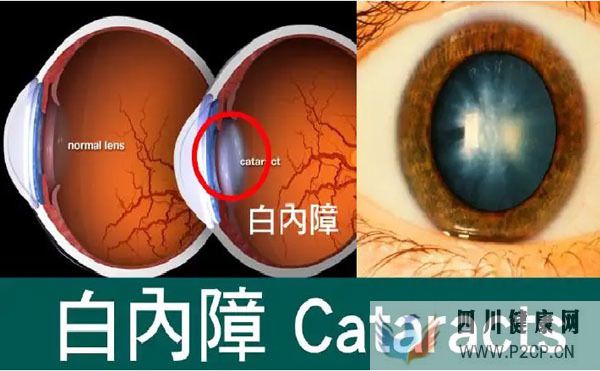 男子眼睛视力下降查出糖尿病，高血糖为何会伤眼？中医辨证疗法(图4)
