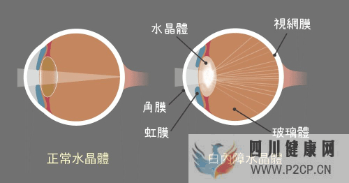 白内障的这些常识你了解吗？(图1)