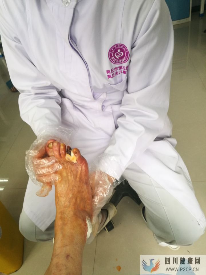 糖尿病患者出现脚趾发黑的现象,是什么原因引起的?(图1) 糖尿病患者出现脚趾发黑的现象,是什么原因引起的?(图1)