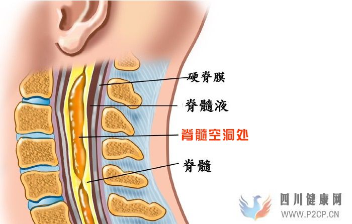 脊髓空洞症诊疗中心：脊髓空洞症的早期都有哪些症状呢应该怎么办(图1)