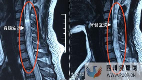 德胜门殷世荣主任:脊髓空洞症都有哪些症状应该怎么办?(图1) 德胜门殷世荣主任:脊髓空洞症都有哪些症状应该怎么办?(图1)