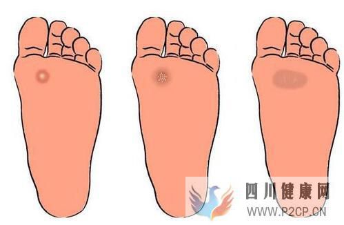 糖尿病患者在出现烂脚之前都是会出现哪些症状，该怎么预防？(图1)