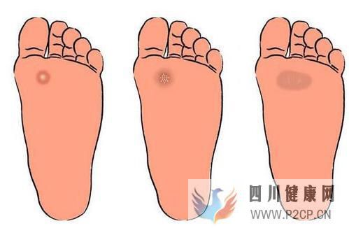 糖尿病患者在出现烂脚之前都是会出现哪些症状,该怎么预防?(图1) 糖尿病患者在出现烂脚之前都是会出现哪些症状,该怎么预防?(图1)