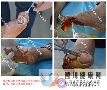 糖尿病导致足部溃烂应该怎么治疗?(图1) 糖尿病导致足部溃烂应该怎么治疗?(图1)