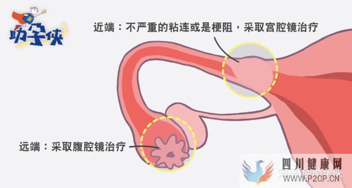 输卵管不通怎么办!(图6)