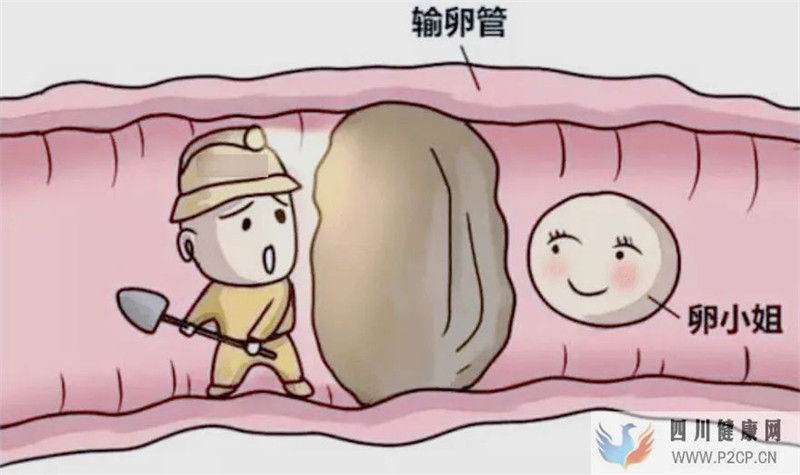 造成输卵管堵塞的原因有哪些(图1) 造成输卵管堵塞的原因有哪些(图1)