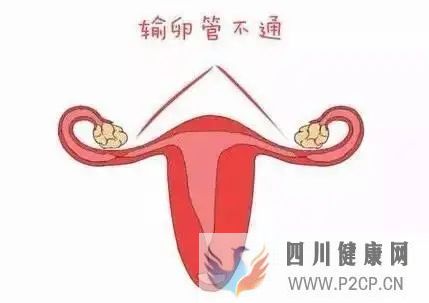 女性为什么会出现输卵管堵塞？(图1)