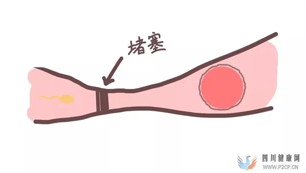 输卵管堵塞的四个级别(图1) 输卵管堵塞的四个级别(图1)