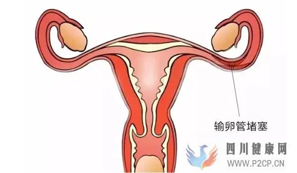 输卵管堵塞有什么办法可以怀孕_(图1)