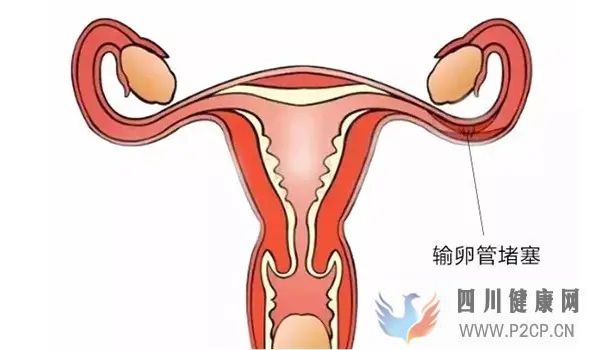 输卵管堵塞有什么办法可以怀孕(图1)