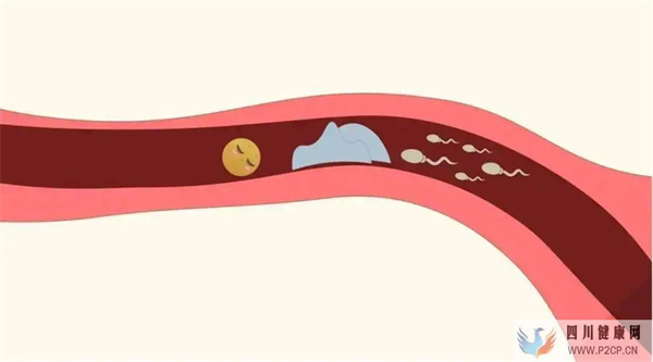 输卵管堵塞还能怀孕吗(图1) 输卵管堵塞还能怀孕吗(图1)