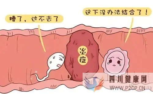 输卵管炎症性不孕的症状(图1) 输卵管炎症性不孕的症状(图1)