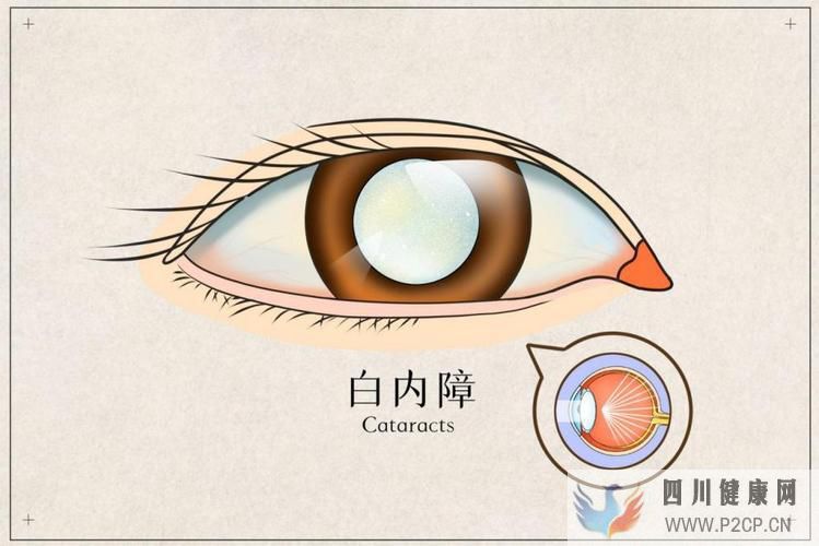哪些人更容易得白内障?(图1) 哪些人更容易得白内障?(图1)