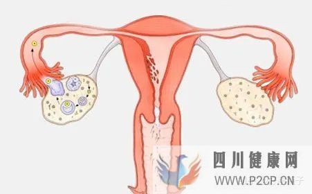 不孕症的自我诊断(图3)