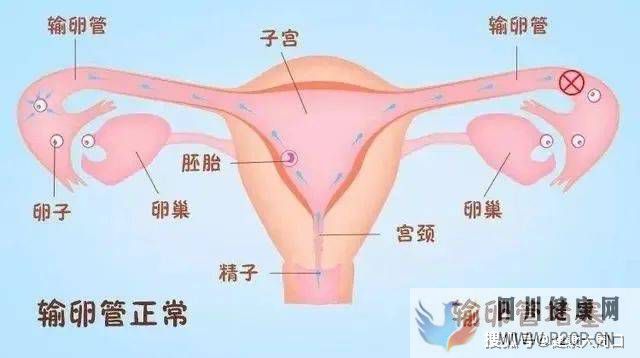 治疗不孕症，为什么往往从“输卵管造影”开始？(图2)