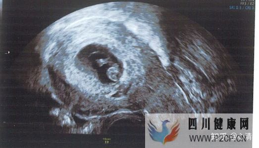产科通关路怀孕、建档、产检、分娩全记录(完结)(图4)