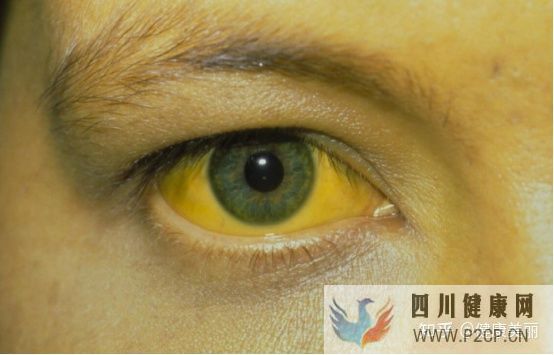 肝病患者长什么样真的和正常人不同吗(图4) 肝病患者长什么样真的和正常人不同吗(图4)
