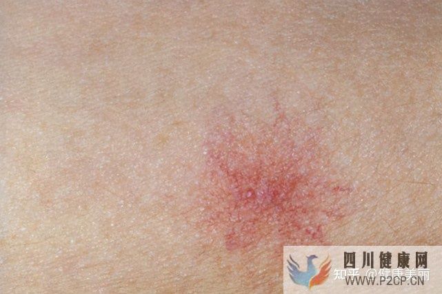 肝病患者长什么样真的和正常人不同吗(图6) 肝病患者长什么样真的和正常人不同吗(图6)