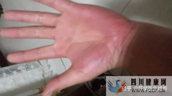 肝病早期的五大症状(图9) 肝病早期的五大症状(图9)