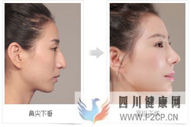 美容整形前一定要知道的美容整形知识(图5) 美容整形前一定要知道的美容整形知识(图5)